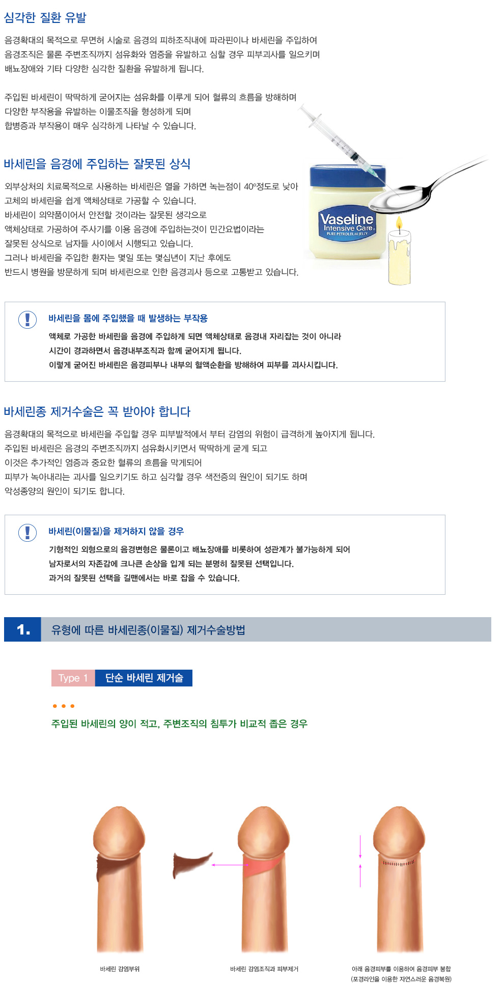 바세린종 제거